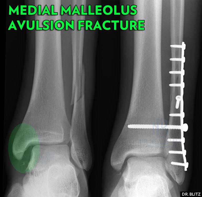 stawu skokowego, kostki przyśrodkowej, przyśrodkowego malleolusa, złamania przyśrodkowego, złamania przyśrodkowego malleolusa, złamań kostki