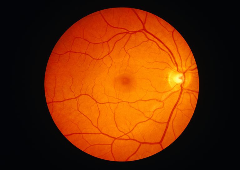 naczynia krwionośne, nerwu wzrokowego, Centralna retinopatia, Centralna retinopatia surowicza, Głowica nerwu, Głowica nerwu wzrokowego
