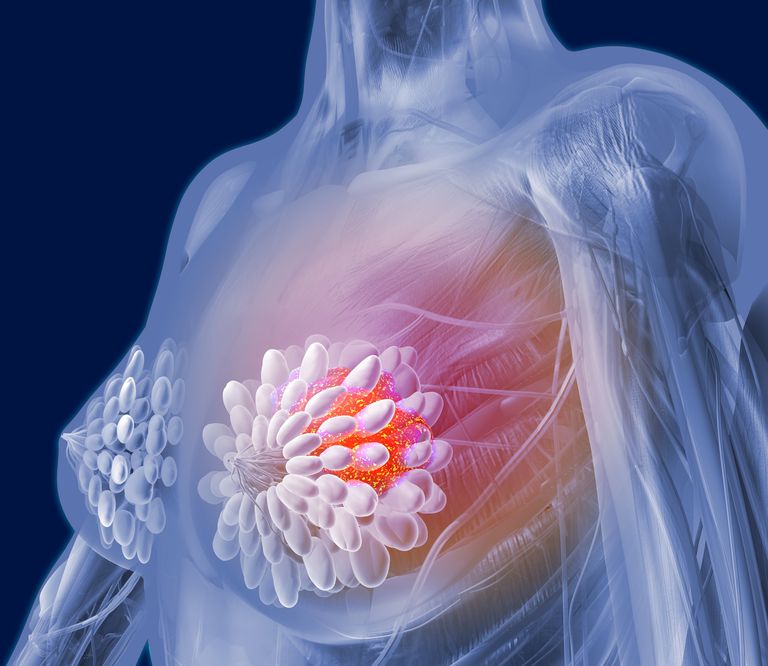 raka piersi, piersi może, Angiosarcoma piersi, naczyniakomięsaka piersi, rodzaj raka, rodzaj raka piersi