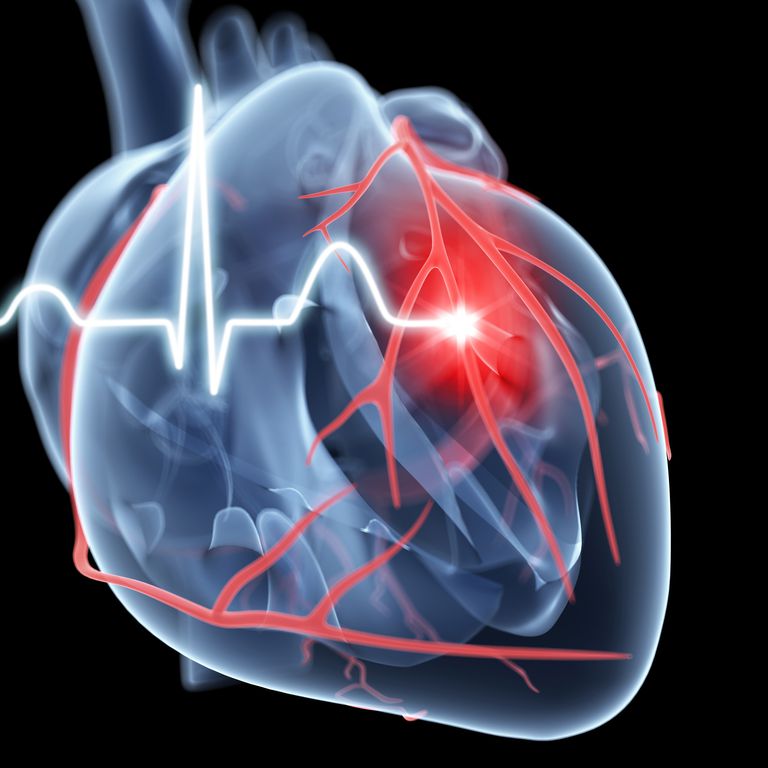 zdarzeń sercowo-naczyniowych, inhibitory PCSK9, Regeneron Sanofi, wyniki badań