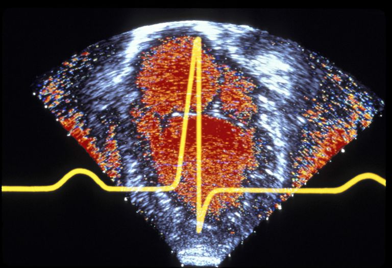 AVRC jest, prawej komory, nagłej śmierci, osób AVRC, kardiomiopatia prawej, kardiomiopatia prawej komory