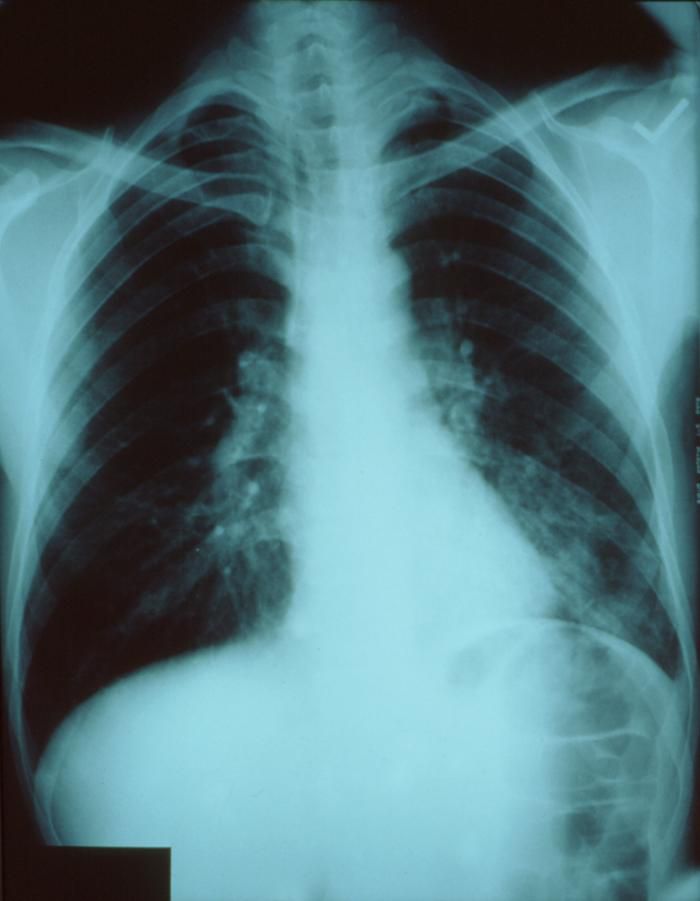 zapalenie płuc, zapalenia płuc, Bakteryjne zapalenie, płuc może, Bakteryjne zapalenie płuc, mogą potrzebne