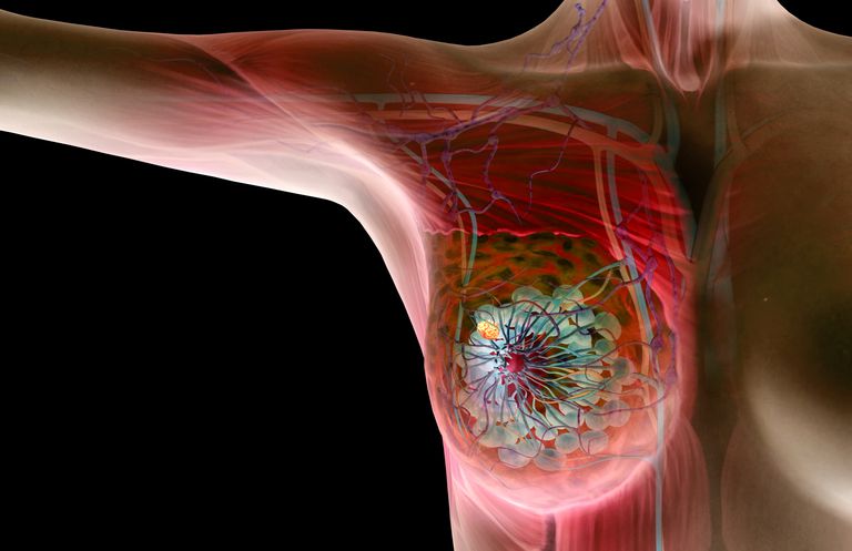 raka piersi, piersi może, guzków piersi, blisko powierzchni, guzek jest