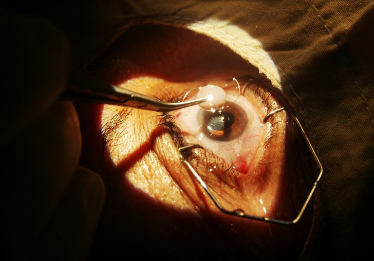operacji zaćmy, usunięcia zaćmy, Krople oczu, Operacja usunięcia