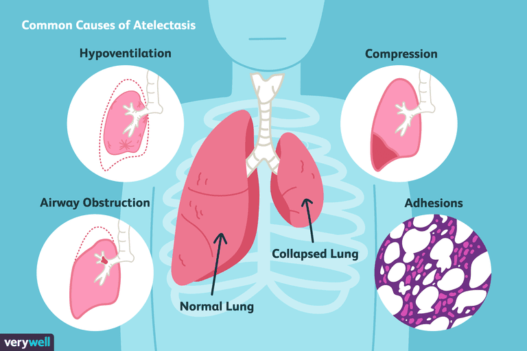 dróg oddechowych, klatki piersiowej, które mogą, część płuc, klatce piersiowej