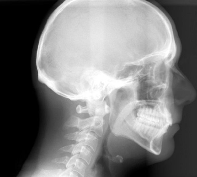 zdjęcia rentgenowskiego, leczenia ortodontycznego, rentgenowskie cefalometryczne, rentgenowskiego cefalometrycznego, rentgenowskiego jest, wykonania zdjęcia