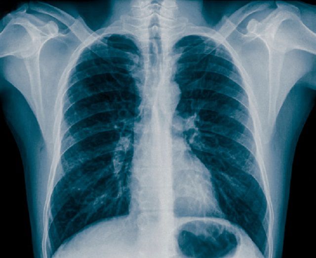 klatki piersiowej, rentgenowskie klatki, rentgenowskie klatki piersiowej, diagnostyce astmy