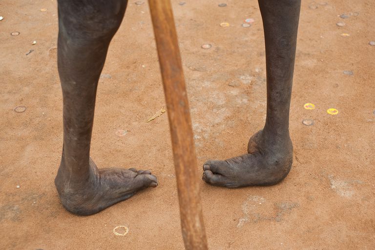 stopy końsko-szpotawej, pozycję stopy, narodzinach dziecka, natychmiastowe leczenie