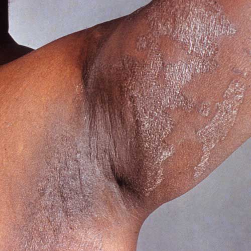 mieszków włosowych, Infekcja może, Staphylococcus aureus, warstwy skóry, Zapalenie mieszków włosowych