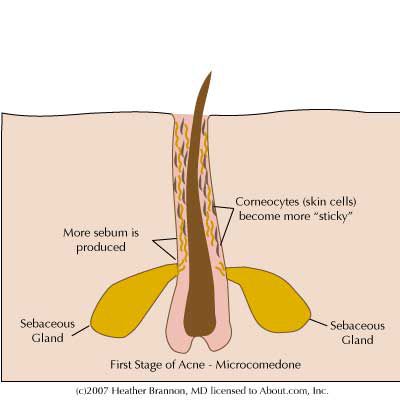 komórek skóry, bakterie acnes, acnes często, Avita odwracają, Avita odwracają lepkość