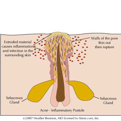 komórek skóry, bakterie acnes, acnes często, Avita odwracają, Avita odwracają lepkość