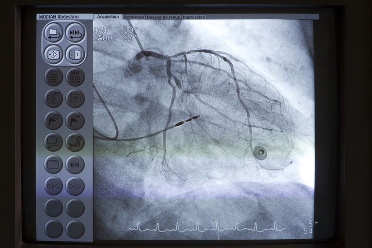 cewnikowanie serca, serca angiografia, cewnikowania serca, przez cewnik, Cewnikowanie serca angiografia