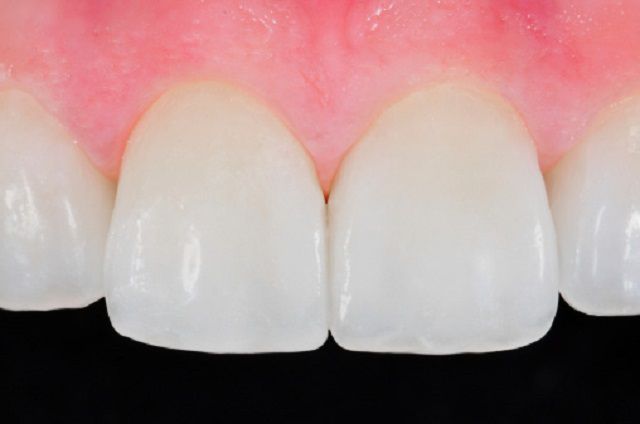 powierzchni zęba, Twój dentysta, znieczulenie miejscowe, będzie wyglądał