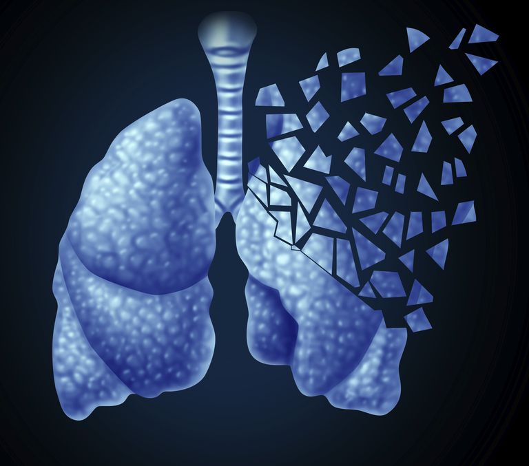 raka płuc, Stanach Zjednoczonych, płuc jest, jest płuc