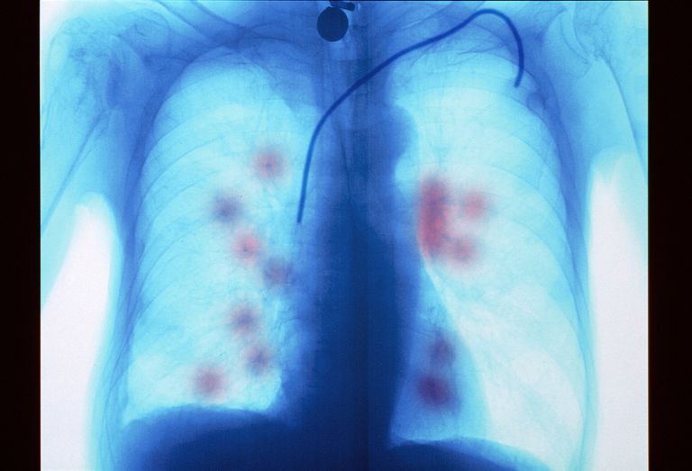 przerzutami płuc, przerzutów płuc, klatki piersiowej, przerzuty płuc, jest często, który rozprzestrzenił