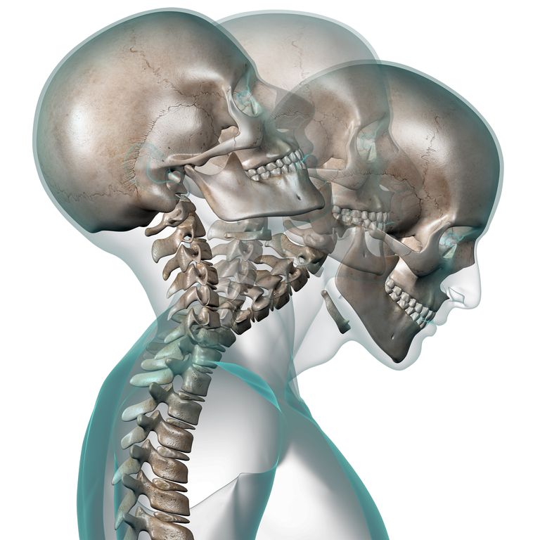 kręgów szyjnych, kręgosłupa szyjnego, uraz kręgosłupa, urazu kręgosłupa, mogą pojawić, może pomóc