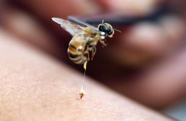 użądlenia pszczół, obrzęk swędzenie, difenhydramina Benadryl, EpiPen Jeśli, Jeśli pacjent