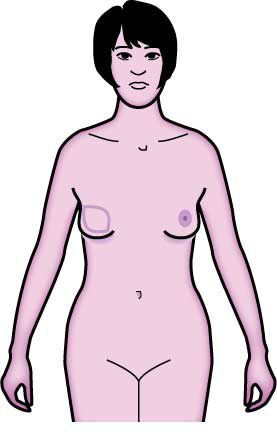 dolnym pośladku, skóry tłuszczu, Klapa IGAP, naczyń krwionośnych, Rekonstrukcja piersi