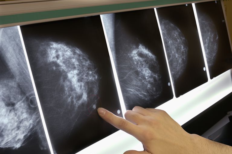 raka piersi, wokół niego, było wieku, masę która, może poruszać