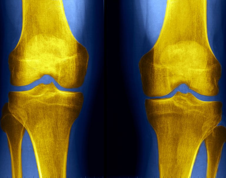 zdjęciu rentgenowskim, można zobaczyć, problemów kolanem, Promienie rentgenowskie, stawu kolanowego, gęstości kości