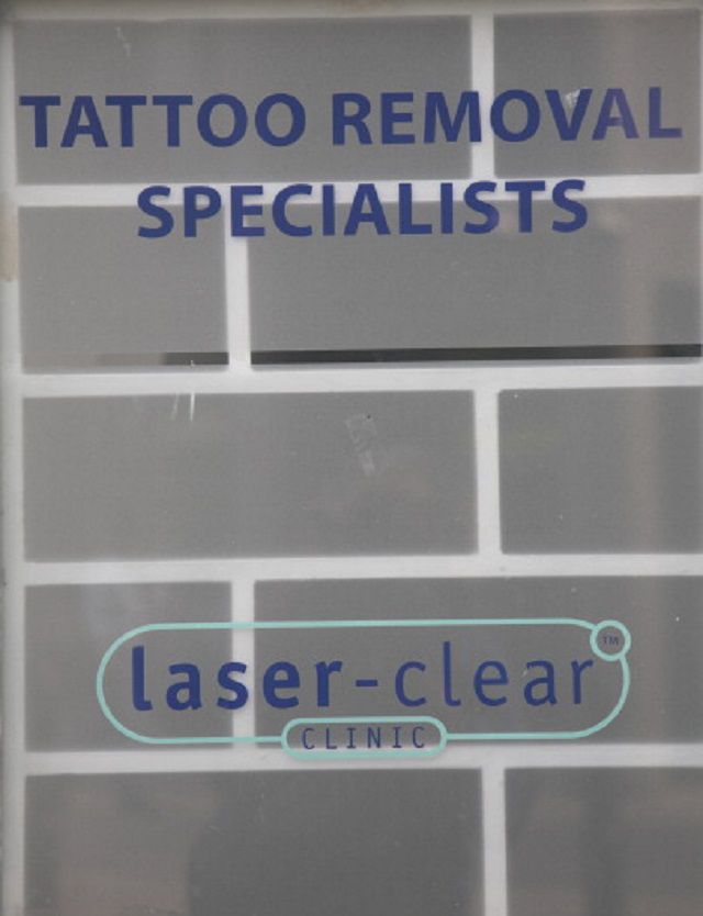 usuwania tatuaży, tatuaży laserowych, usuwania tatuaży laserowych, usuwanie tatuaży