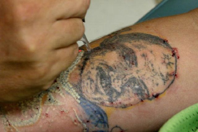 usuwania tatuaży, tatuaży laserowych, usuwania tatuaży laserowych, usuwanie tatuaży