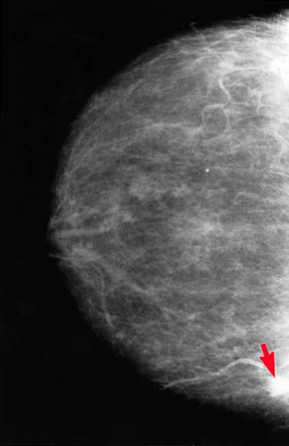 raka piersi, gęsta tkanka, które mogą, gęsta tkanka piersi, tkanka piersi, tkankę piersiową