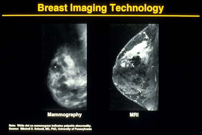 raka piersi, gęsta tkanka, które mogą, gęsta tkanka piersi, tkanka piersi, tkankę piersiową