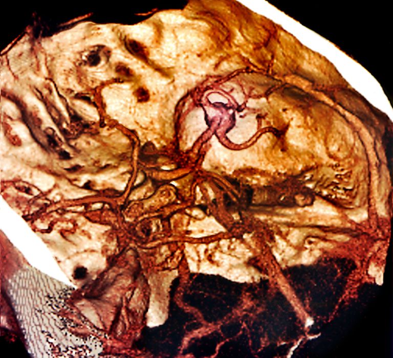 tętnica mózgowa, środkowej mózgu, tętnicy środkowej, tętnicy środkowej mózgu, części mózgu, głowy szyi