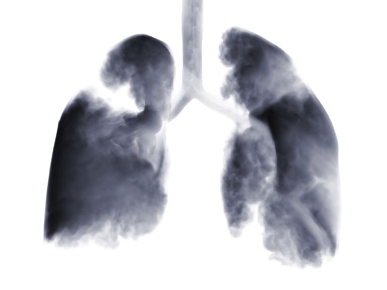raka płuc, około procent, raki płuca, Niedrobnokomórkowe raki