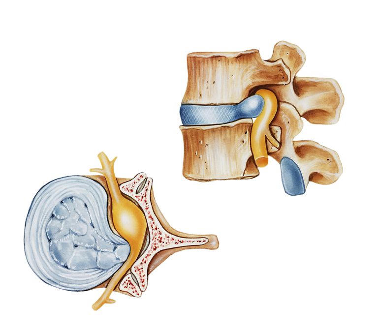 nerwu rdzeniowego, rdzenia kręgowego, jest często, kanał kręgowy, korzeń nerwu, korzenia nerwu