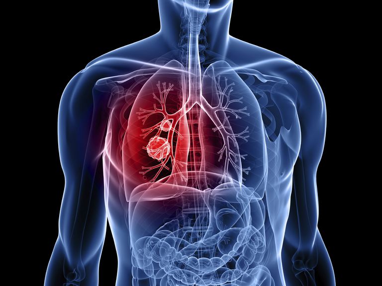 raka płuc, rakiem płuc, niedrobnokomórkowego raka, raka płuca, niedrobnokomórkowego raka płuc