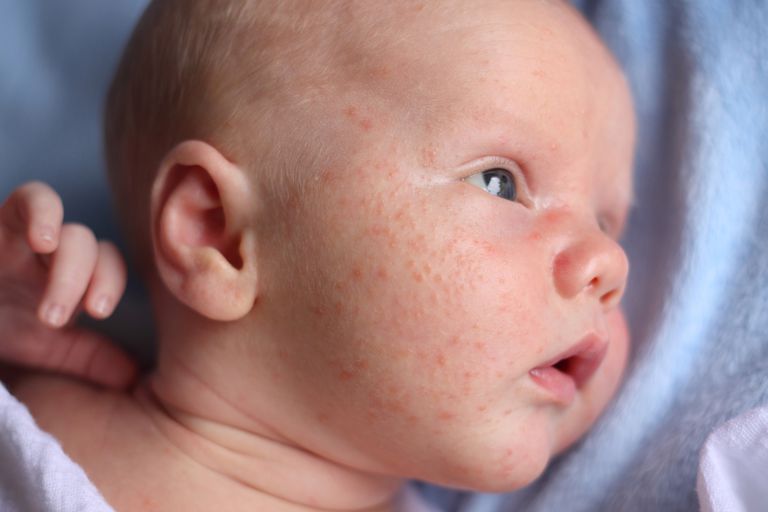 trądziku niemowlęcego, niemowlęcy jest, infekcyjnym trądzikiem, dziecka zwłaszcza, Jeśli trądzik, które powodują