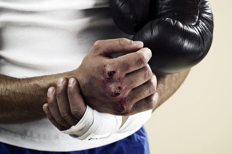 złamania boksera, złamaniu boksera, terapii fizycznej, złamanie boksera, boksera dłoni, boksera może
