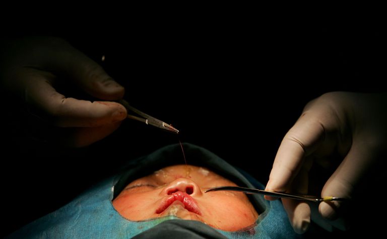 chirurgii plastycznej, chirurgia plastyczna, Chirurgia kosmetyczna, Chirurgia kosmetyczna jest