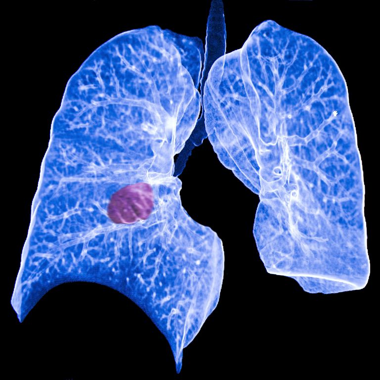raka płuc, pierwotny płuc, rakiem płuc, pierwotnego raka, raka płuca, drugi płuca