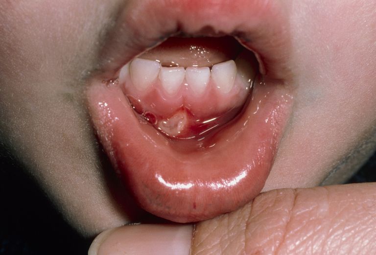 jamy ustnej, mogą również, owrzodzeń jamy, owrzodzeń jamy ustnej, płukania jamy, płukania jamy ustnej
