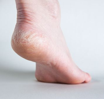 zapalenie skóry, powodują swędzenie, skóry które, swędzenie stóp, Atopowe zapalenie skóry