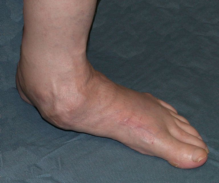 płaska stopa, płaskich stóp, płaskimi stopami, jest płaska, mięśnie stopy
