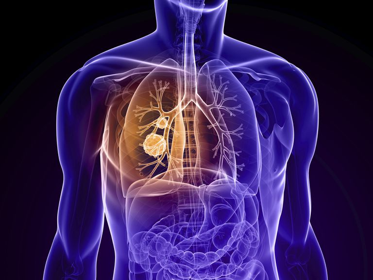 raka płuca, płuca stadium, raka płuc, rakiem płuca, rakiem płuca stadium, badania kliniczne