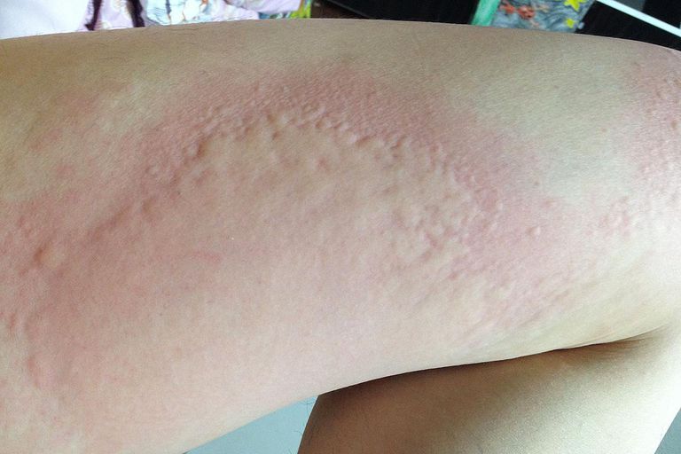 alergii sulfonamidy, stosowany leczeniu, Należą nich, należy unikać