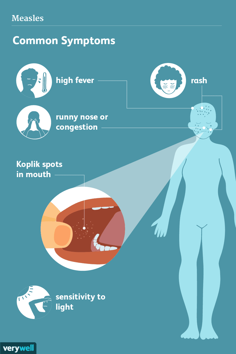 infekcji wirusowych, może prowadzić, nerwu wzrokowego, wysypka odry, ciągu pierwszych, innych infekcji