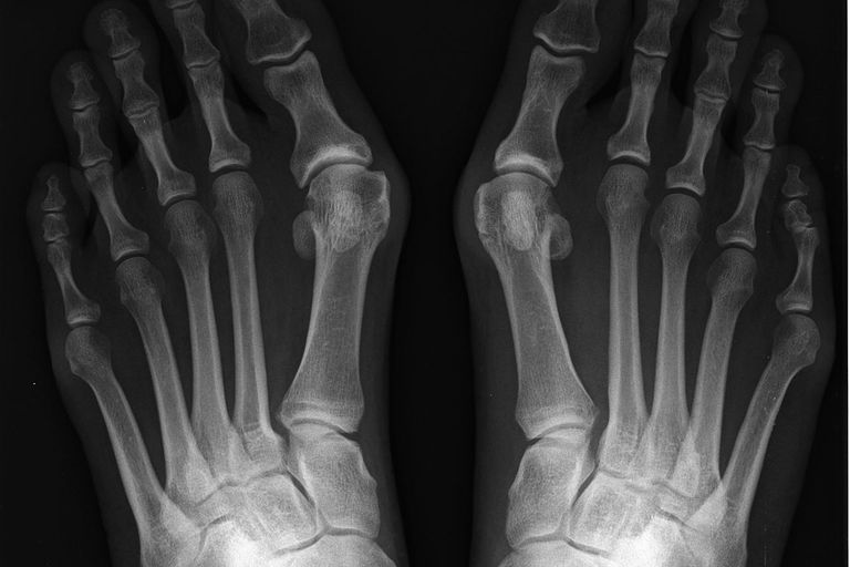 kości śródstopia, piątej kości, piątej kości śródstopia, znany jako, funkcji stopy, funkcjonowanie stopy