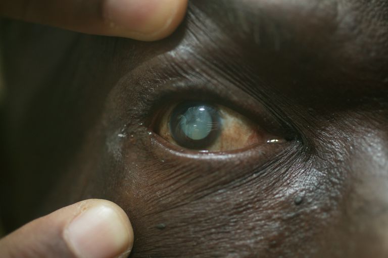 diagnozowania zaćmy, ostrości wzroku, zaćma może, jakość widzenia