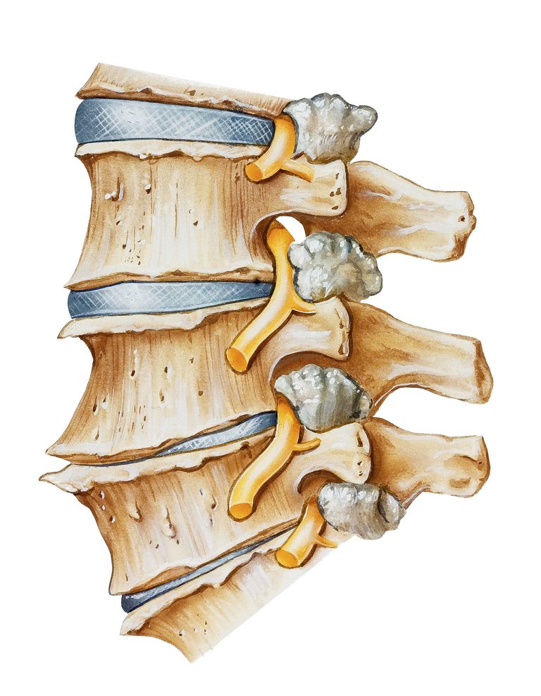 krążka międzykręgowego, kręgosłupa lędźwiowego, artykule zatytułowanym, dolna para, dolna para osteofitów