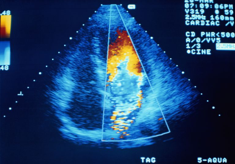 klatki piersiowej, fale dźwiękowe, Echokardiogram przezprzełykowy, jest przydatny, można uzyskać, obrazy serca