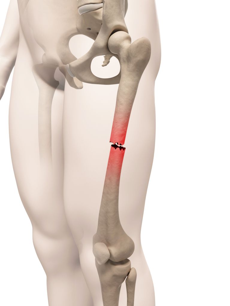kości udowej, stawu kolanowego, udowej jest, kości udowej jest, Bliższe złamania, Bliższe złamania kości