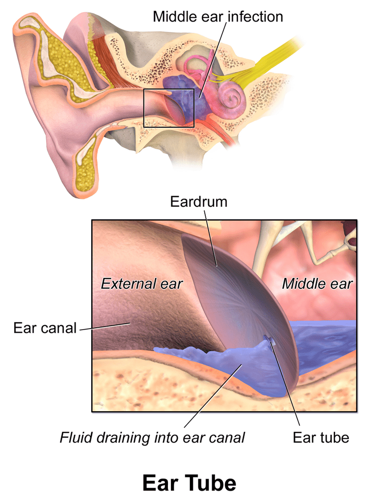 Rury wentylacyjne, ucha środkowego, zatyczki uszu, Fluid uchu, jest bardzo