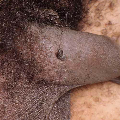narządów płciowych, mogą wyglądać, brodawka palcu, mogą wyglądać inaczej, okolicy narządów