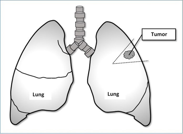 raka płuc, raka płuca, rakiem płuc, resekcję klina, resekcji klina, klatki piersiowej